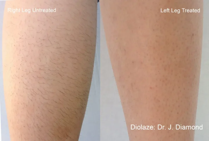 diolaze laser hair removal