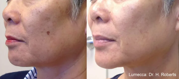 lumecca ipl photofacial in Beverly Hills