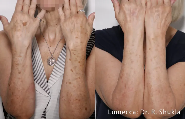 Beverly Hills IPL photofacial