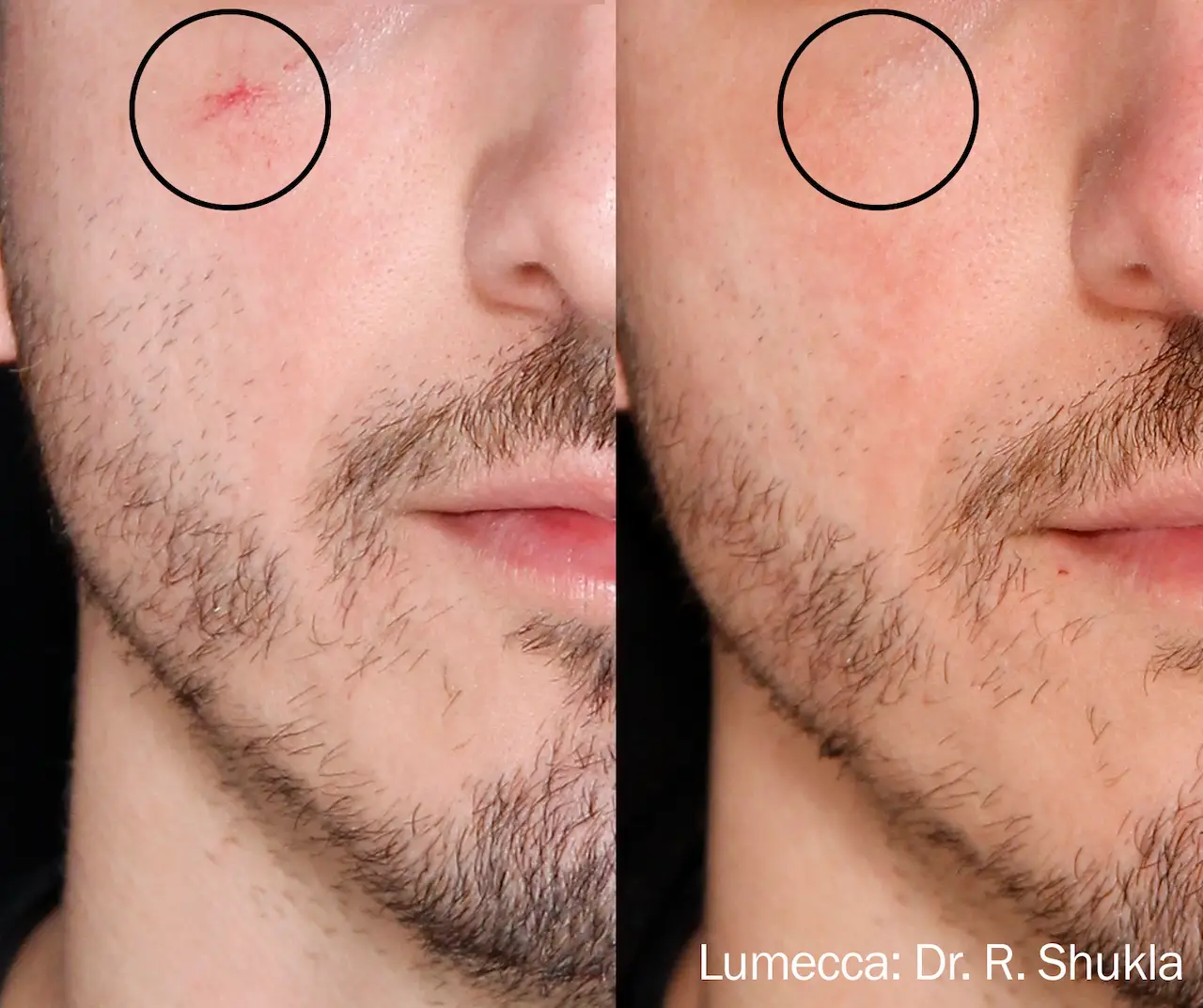 lumecca IPL photofacial before and after