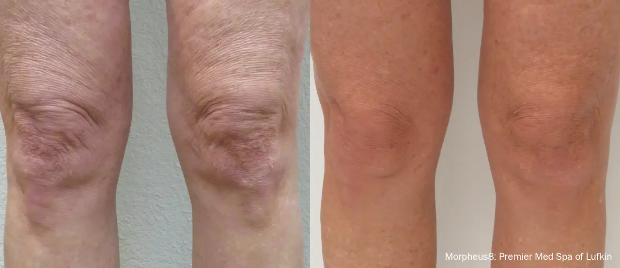 morpheus8 before and after
