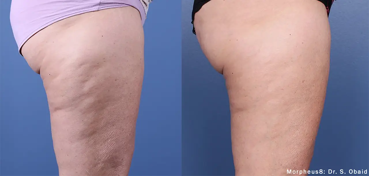morpheus8 before and after