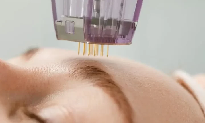 M8 needles to face