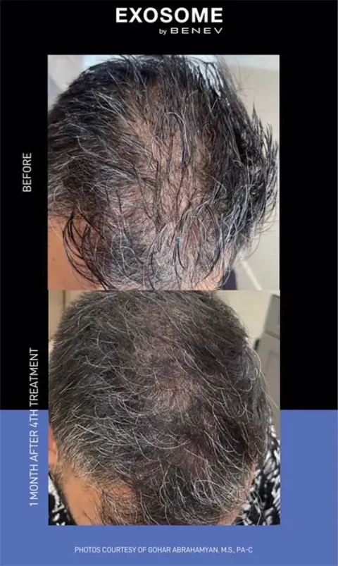 exosome before and after