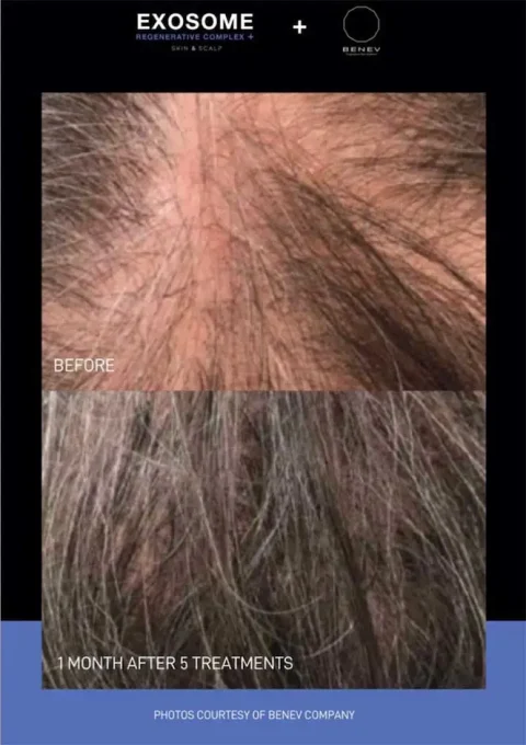 exosome before and after