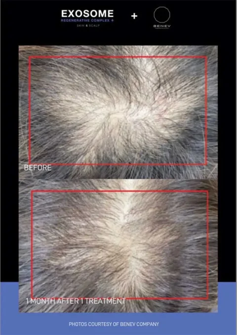 exosome before and after