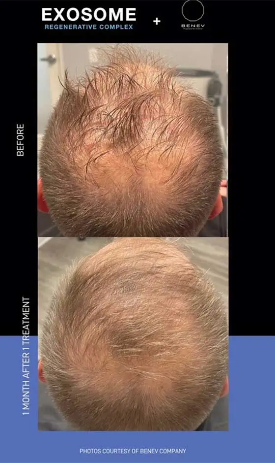 exosome before and after