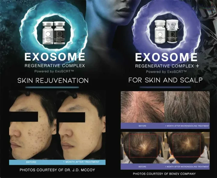 skin rejuvenation with exosomes