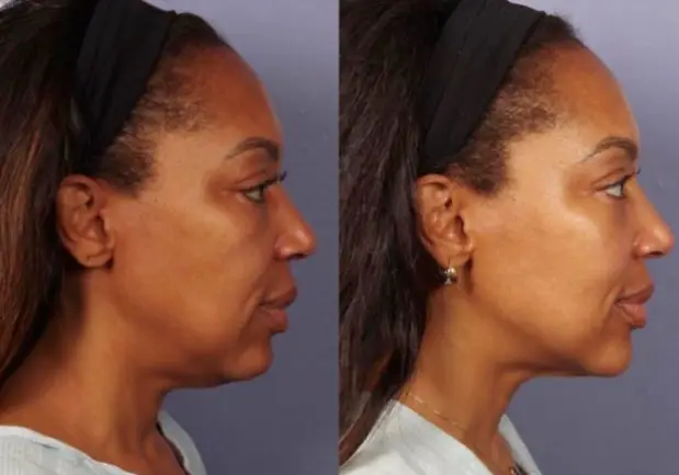 morpheus8 before and after