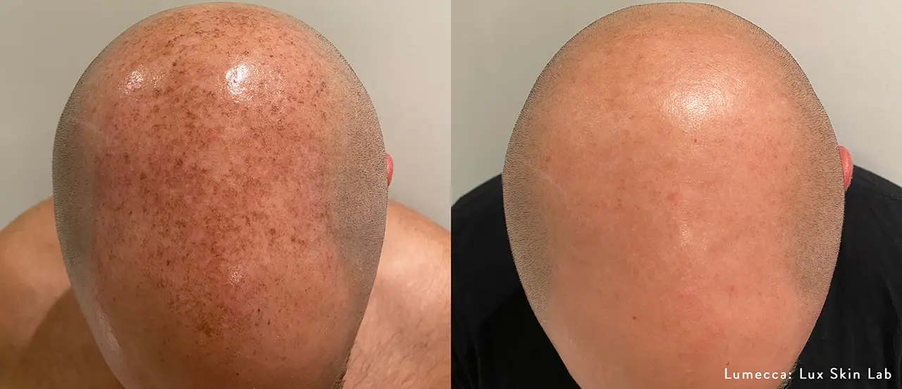 lumecca IPL photofacial before and after