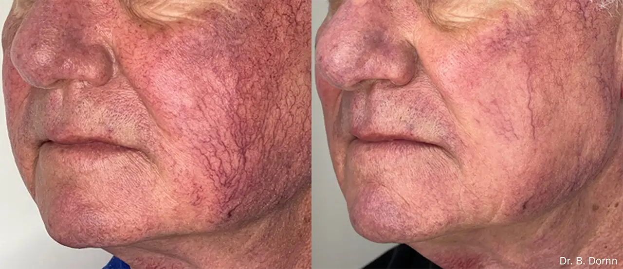 lumecca IPL photofacial before and after