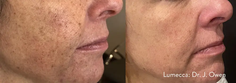 lumecca IPL photofacial before and after