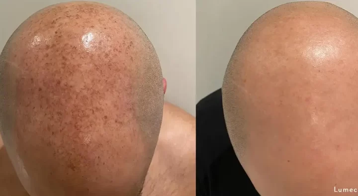 lumecca ipl hair