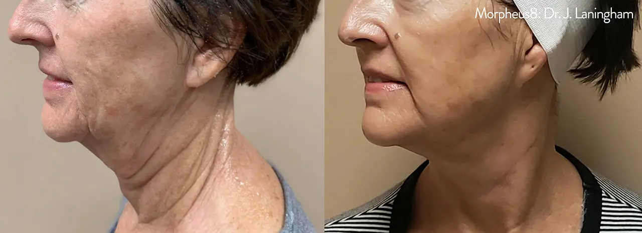 morpheus8 before and after