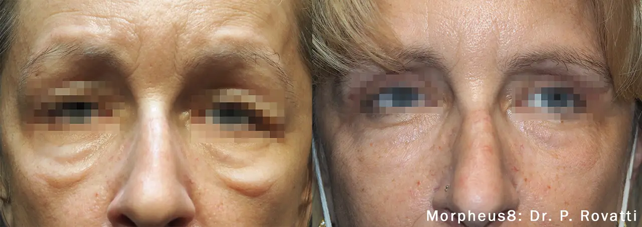 morpheus8 before and after