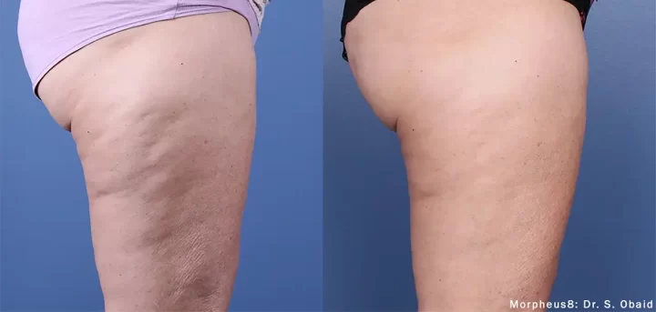 morpheus8 buttock enhancement in Beverly Hills