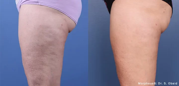 cellulite treatment in Beverly Hills